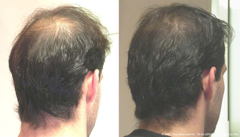 თმის მეზოთერაპია - თმის ცვენის მკურნალობის უმტკივნეულო, არაქირურგიული მეთოდი