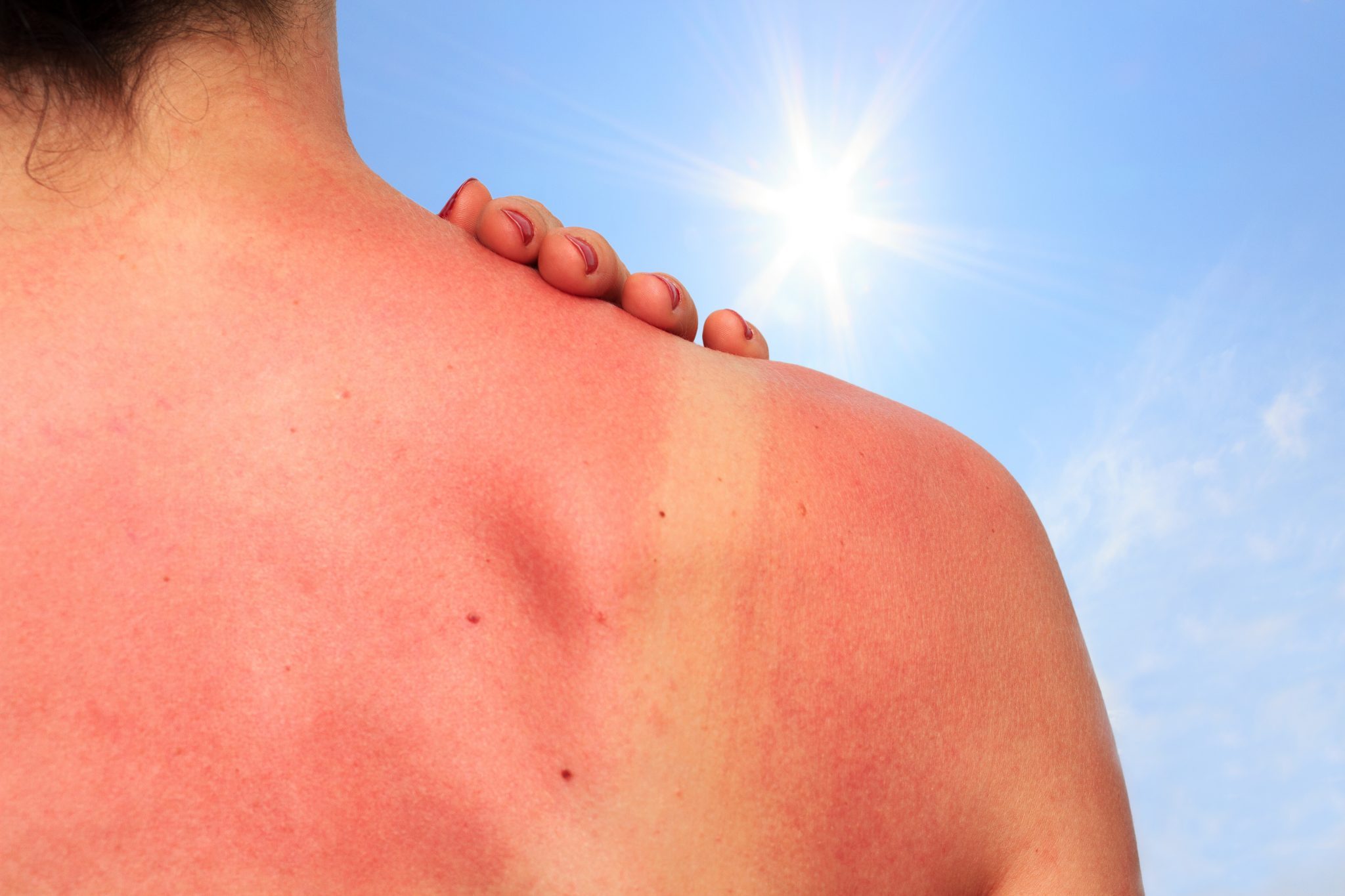 კანის დაბერების მთავარი მიზეზი მზის სხივებია - ყველაფერი, რაც მზისგან მიღებულ ზიანზე უნდა იცოდეთ