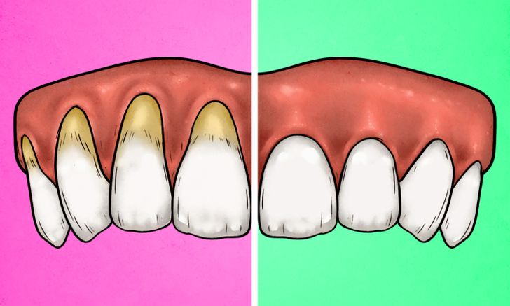 3 ნიშანი იმისა, რომ კბილებს ძალიან უხეშად იხეხავთ - როგორ მოვაგვაროთ პრობლემა?